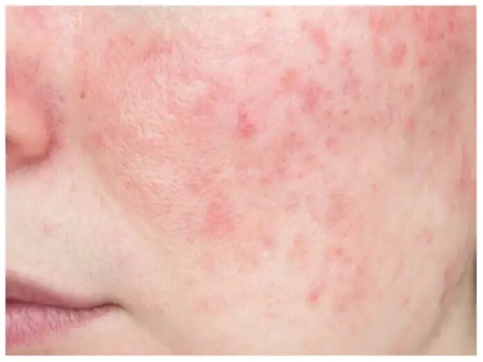 Rosacea Causes Symptoms And Treatment Skin Redness What Is Rosacea