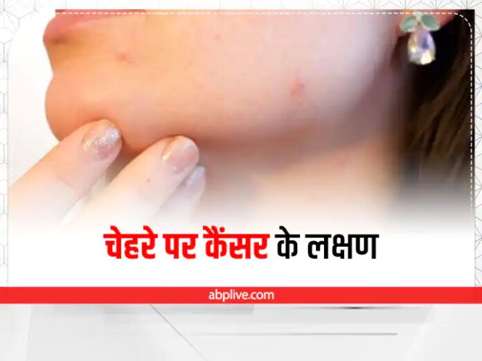 Skin Cancer Warning Signs And Symptoms In Hindi
