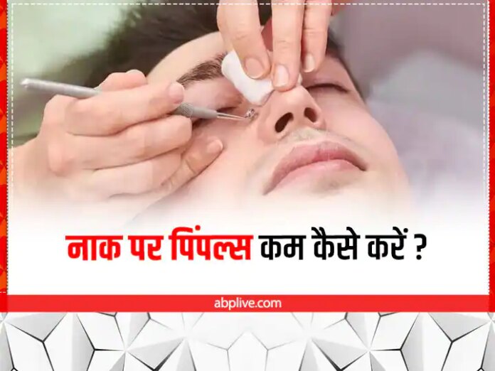 Home Remedies To Remove Nose Pimples