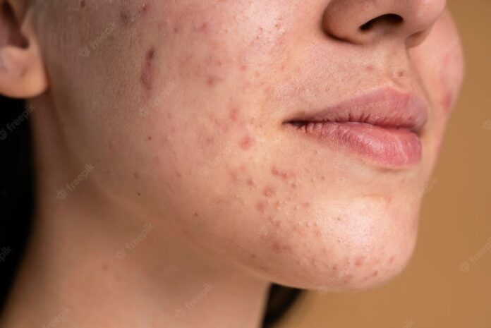 Taking Antibiotics To Clear Acne Affects Bone Growth
