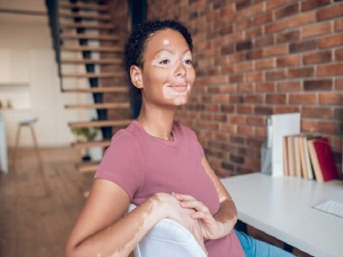 Vitiligo Symptoms This Causes The Problem Of White Spots In The Skin Know...