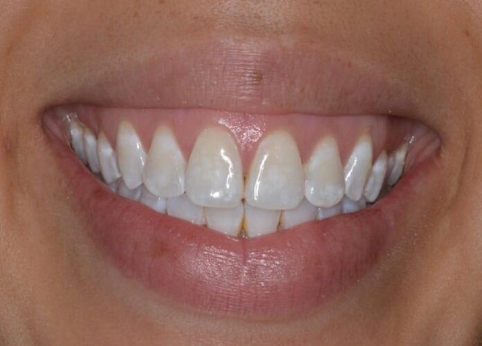 White Spots On Teeth Do Not Take Lightly The White Spots On The Teeth, Here...