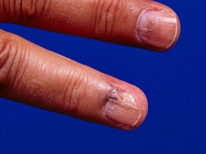 World Cancer Day Never Ignore This One Sign On Your Nail