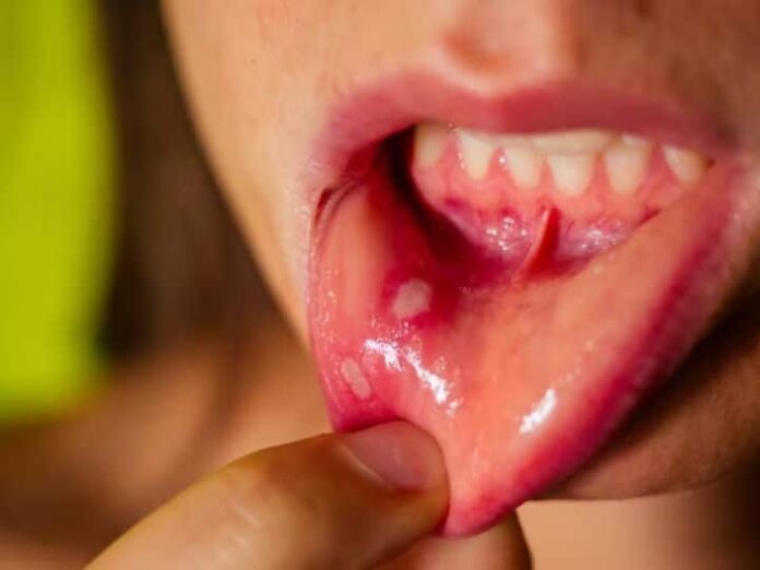 Mouth Cancer Symptoms Causes Treatment That Everyone Should Know