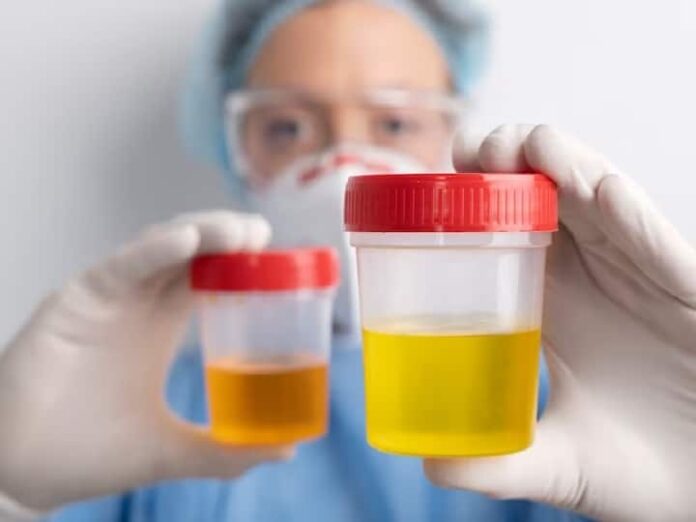 Urine Color Tells How Is Your Health Such Color Can Be A Sign Of These...
